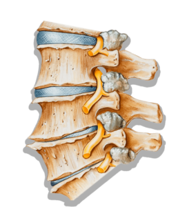 spondylarthrite