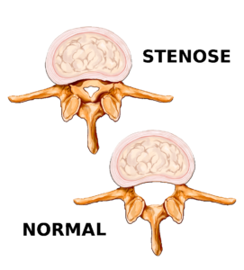 Sténose spinal