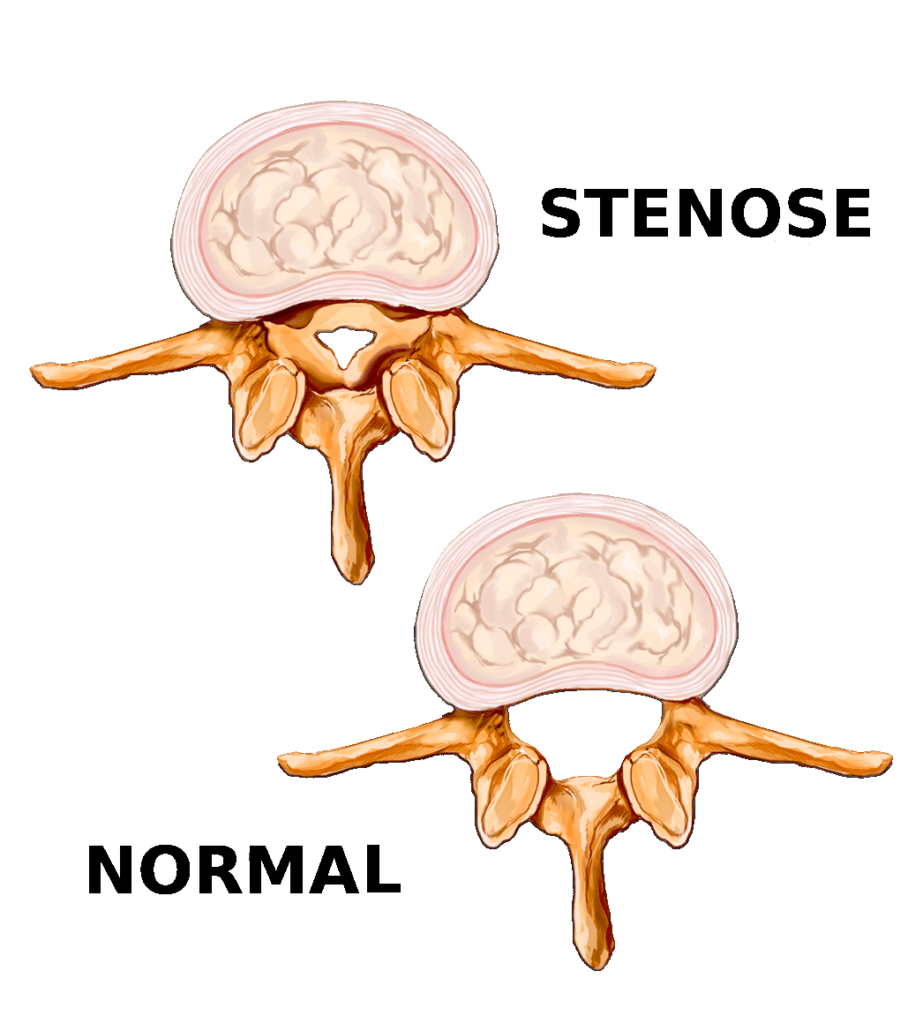 Sténose spinal