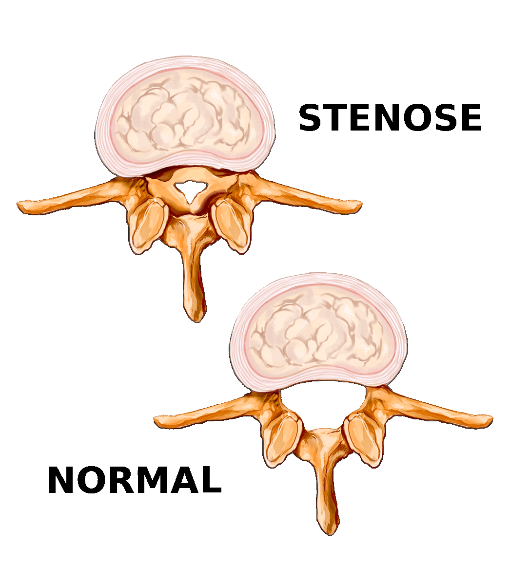 Sténose spinal